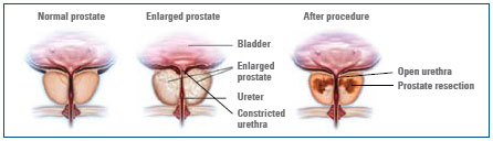 Kegels Prostate Health Men