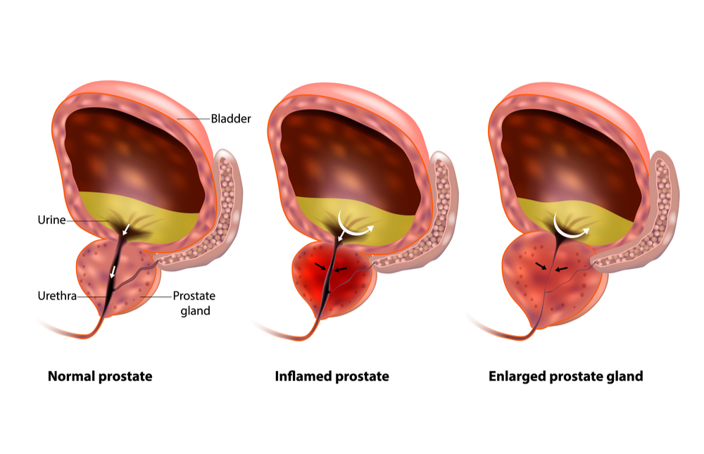 Male Prostate Problems