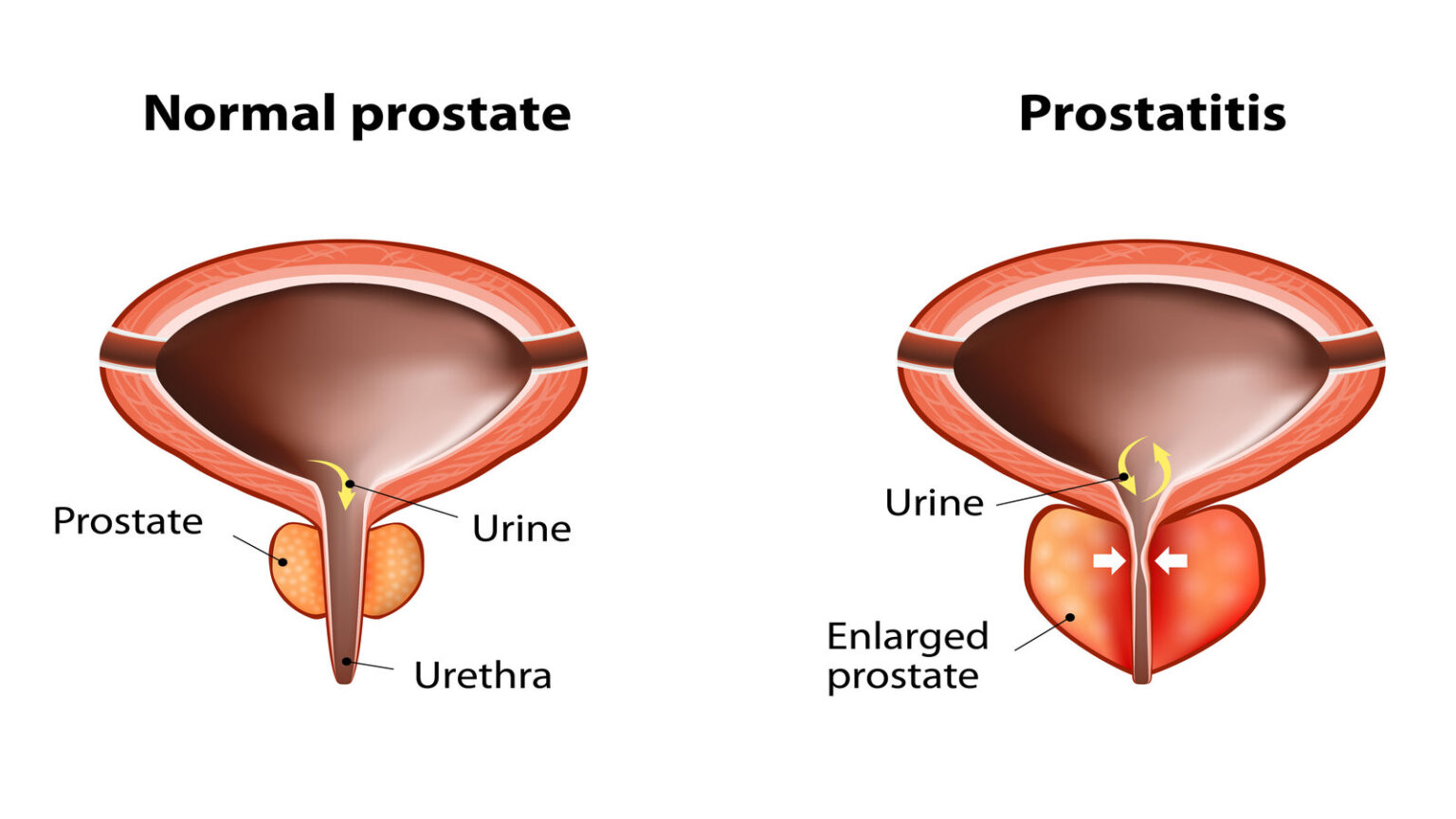 Male Prostate Gland Problems