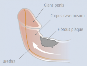 Peyronies Disease Brisbane NewZealand